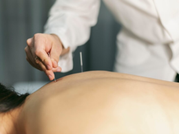 Acupuntura