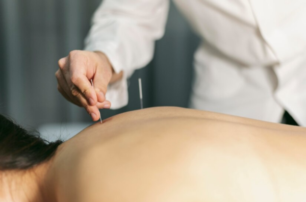 Acupuntura